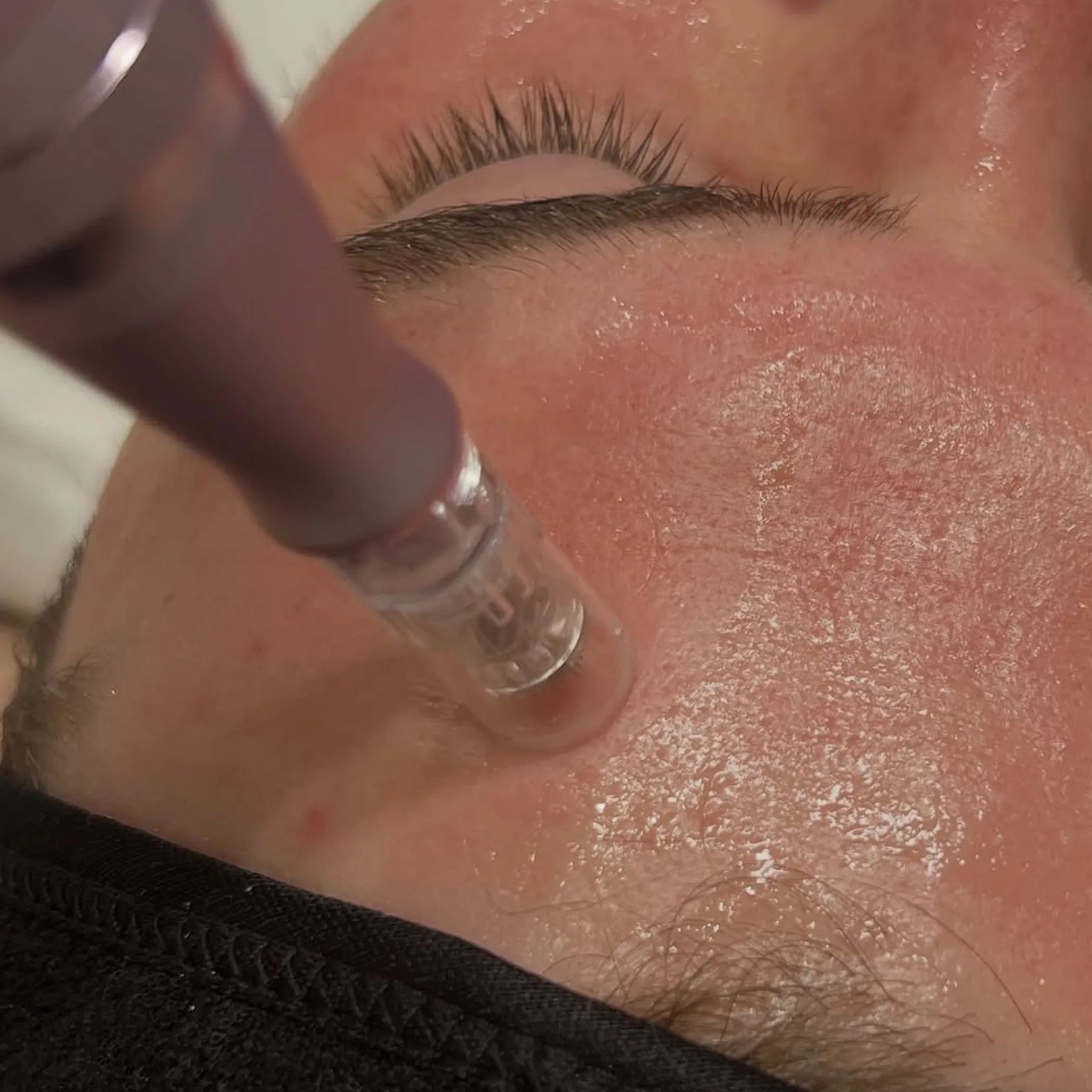 microneedling skin treatment procedure