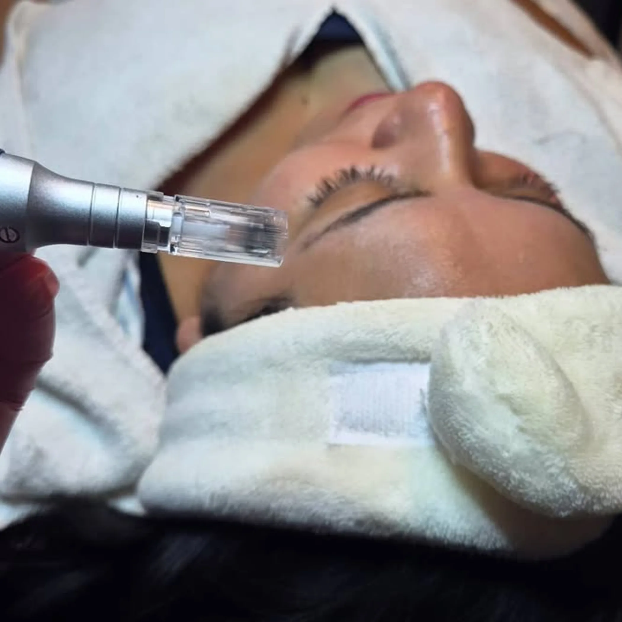 skin needling with a dermapen
