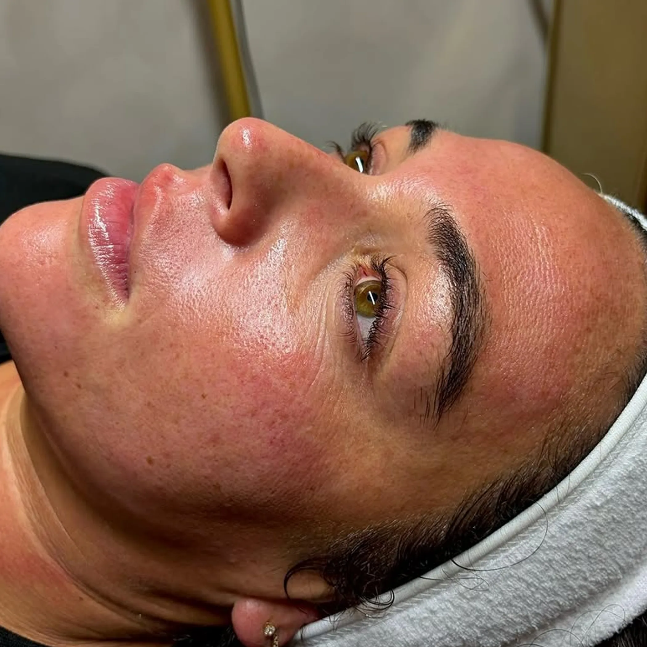 microneedling client treatment