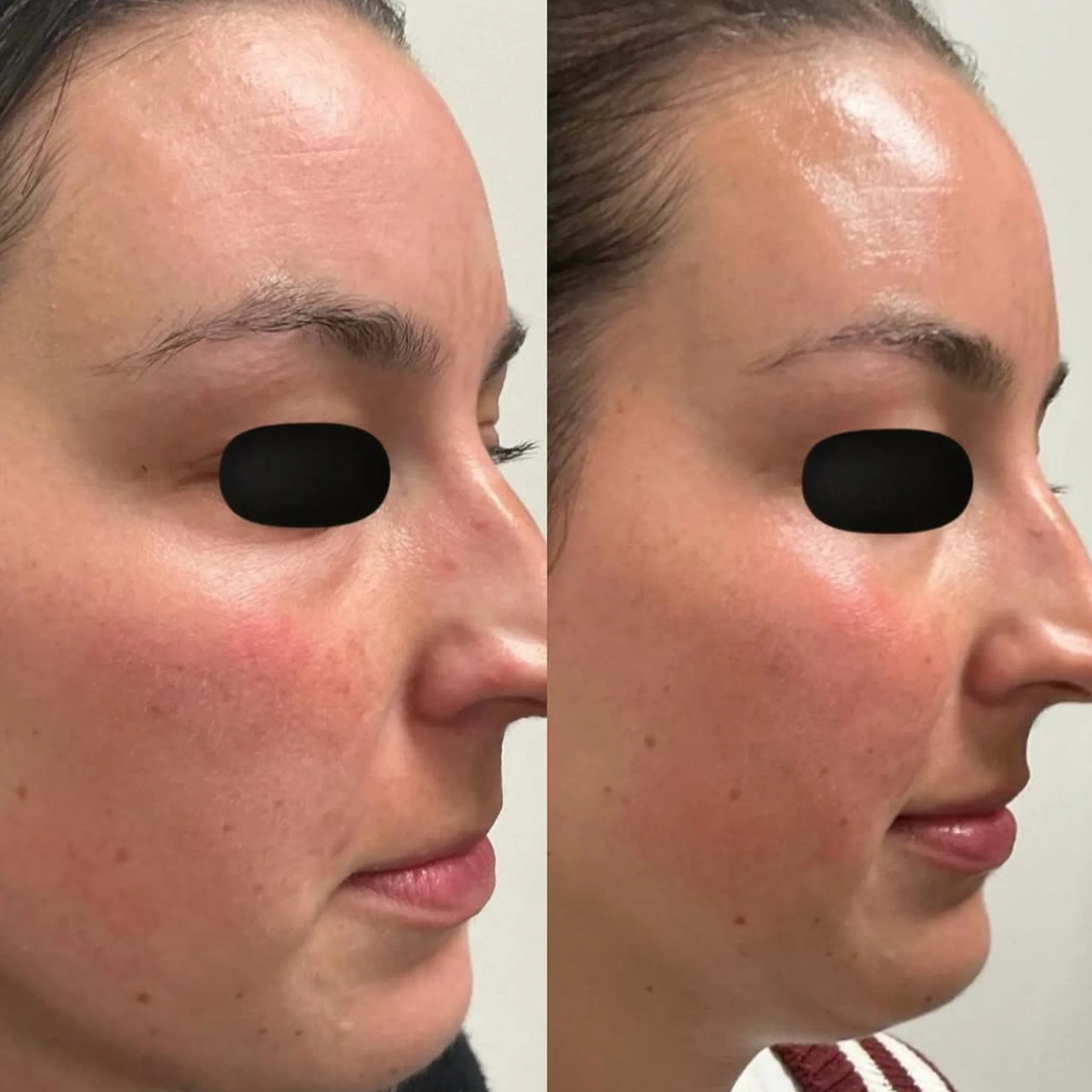 improved facial skin texture comparison