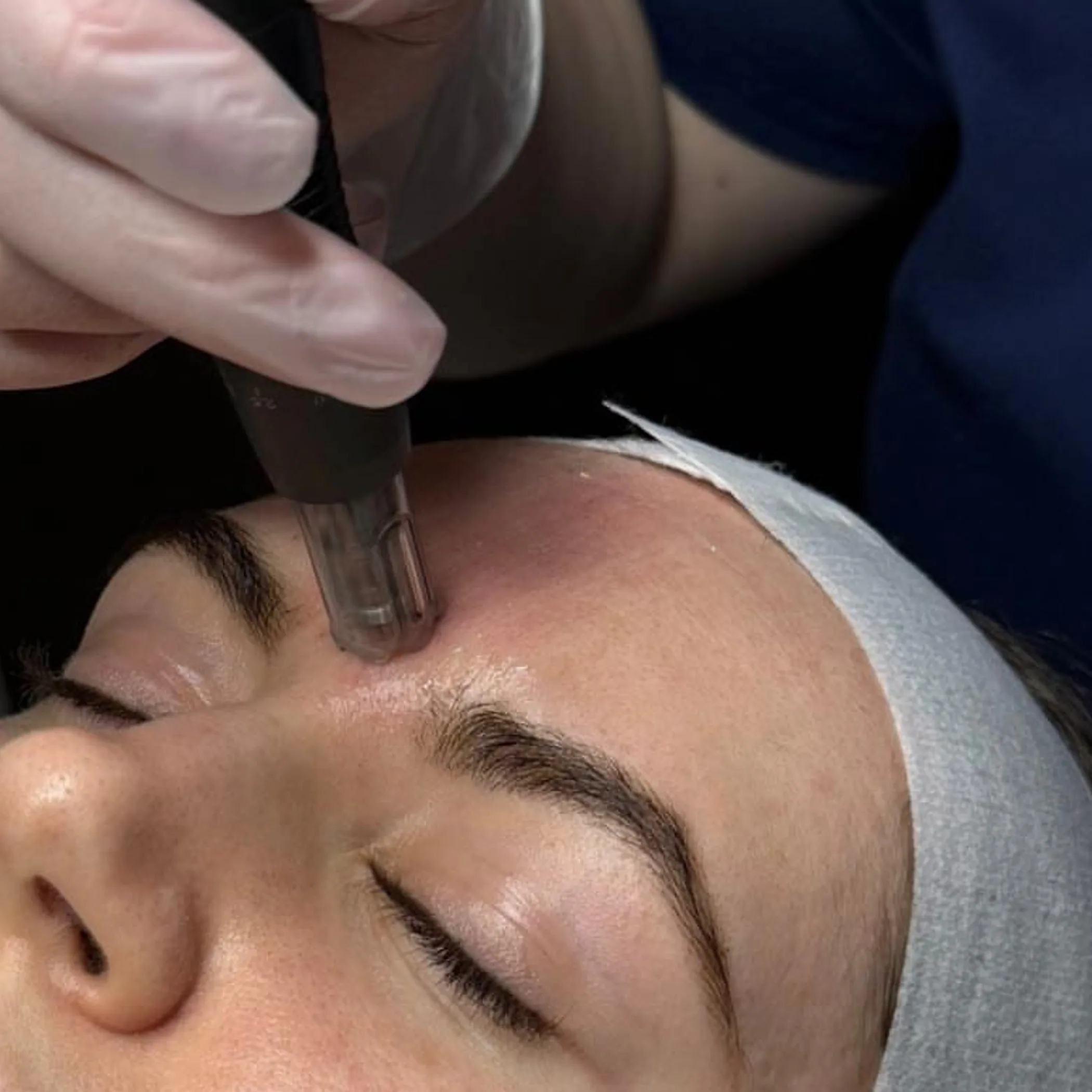 microneedling treatment on facial skin